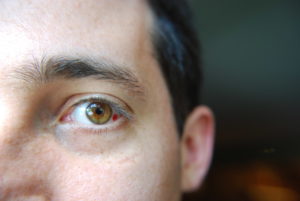 Наловился зайчиков от сварки что делать