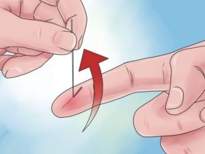 Как вытащить металлическую занозу из пальца