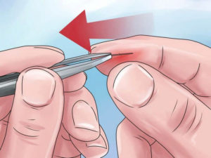 Как вытащить металлическую занозу из пальца