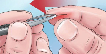 Как вытащить металлическую занозу из пальца