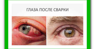 Как избавиться от зайчиков после сварки